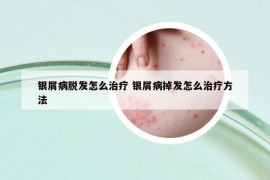 銀屑病脫發(fā)怎么治療 銀屑病掉發(fā)怎么治療方法