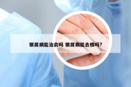 銀屑病能治俞嗎 銀屑病能去根嗎?