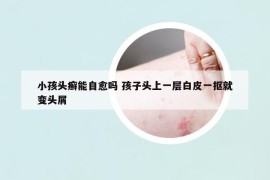 小孩頭癬能自愈嗎 孩子頭上一層白皮一摳就變頭屑
