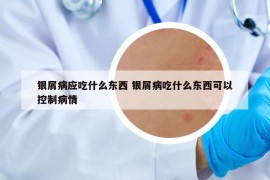 銀屑病應(yīng)吃什么東西 銀屑病吃什么東西可以控制病情