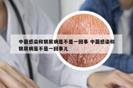 中菌感染和銀屑病是不是一回事 中菌感染和銀屑病是不是一回事兒