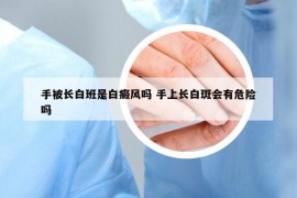 手被長白班是白癜風(fēng)嗎 手上長白斑會有危險嗎
