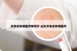 濟南皮膚病醫(yī)院哪家好 山東濟南皮膚病醫(yī)院