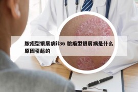 膿皰型銀屑病il36 膿皰型銀屑病是什么原因引起的