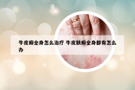 牛皮癬全身怎么治療 牛皮膚癬全身都有怎么辦