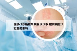 皮膚ct診斷銀屑病會(huì)誤診不 銀屑病做ct能查出來嗎