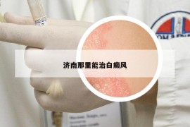 濟(jì)南那里能治白癜風(fēng)