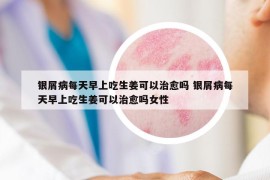 銀屑病每天早上吃生姜可以治愈嗎 銀屑病每天早上吃生姜可以治愈嗎女性