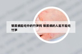 銀屑病能吃炒的竹筍媽 銀屑病的人能不能吃竹筍