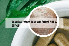 銀屑病cart靶點(diǎn) 銀屑病靶向治療有什么副作用