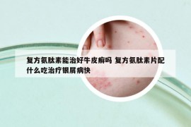 復(fù)方氨肽素能治好牛皮癬嗎 復(fù)方氨肽素片配什么吃治療銀屑病快