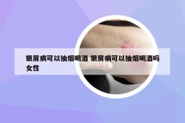 銀屑病可以抽煙喝酒 銀屑病可以抽煙喝酒嗎女性