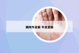 廁所牛皮癬 牛皮皮癬