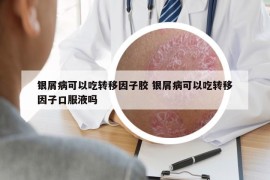 銀屑病可以吃轉移因子膠 銀屑病可以吃轉移因子口服液嗎