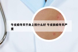 牛皮癬冬天干身上擦什么好 牛皮膚癬冬天嚴(yán)重