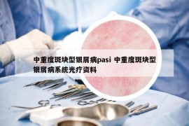 中重度斑塊型銀屑病pasi 中重度斑塊型銀屑病系統(tǒng)光療資料