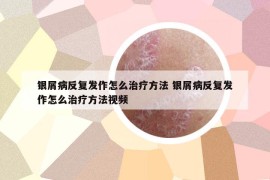銀屑病反復(fù)發(fā)作怎么治療方法 銀屑病反復(fù)發(fā)作怎么治療方法視頻