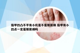 指甲凹凸不平有小坑是不是銀屑病 指甲有小凹點一定是銀屑病嗎
