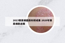 2023銀屑病最新科研成果 2020年銀屑病新進展