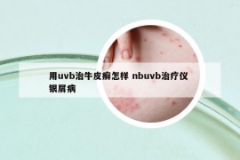 用uvb治牛皮癬怎樣 nbuvb治療儀 銀屑病