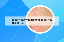 tdp治療儀對牛皮癬的作用 tdp治療儀多少錢一臺