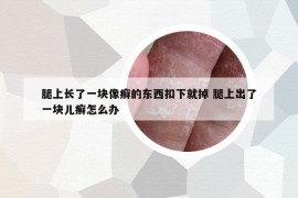 腿上長了一塊像癬的東西扣下就掉 腿上出了一塊兒癬怎么辦