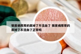 銀屑病厚厚的屑掉了不流血了 銀屑病厚厚的屑掉了不流血了正常嗎