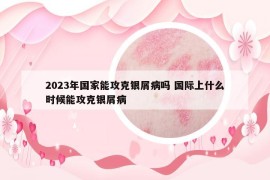2023年國家能攻克銀屑病嗎 國際上什么時候能攻克銀屑病
