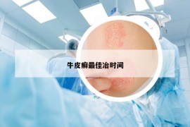牛皮癬最佳冶時(shí)間