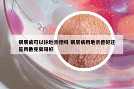 銀屑病可以抹地奈德嗎 銀屑病用地奈德好還是用他克莫司好