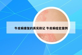 牛皮癬康復的真實故記 牛皮癬痊愈案例