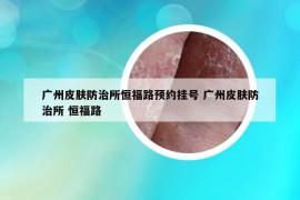 廣州皮膚防治所恒福路預(yù)約掛號 廣州皮膚防治所 恒福路