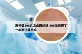 激光做308幾次白斑能好 308激光照了一年半還要照嗎