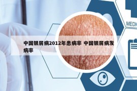 中國銀屑病2012年患病率 中國銀屑病發(fā)病率