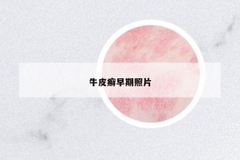 牛皮癬早期照片