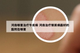 河南哪里治療牛皮癬 河南治療銀屑病最好的醫(yī)院在哪里