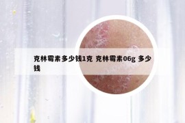 克林霉素多少錢1克 克林霉素06g 多少錢