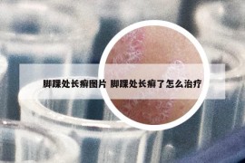 腳踝處長癬圖片 腳踝處長癬了怎么治療