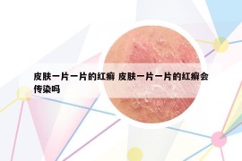 皮膚一片一片的紅癬 皮膚一片一片的紅癬會傳染嗎