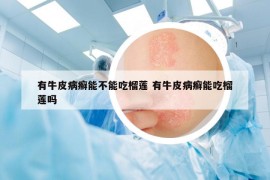 有牛皮病癬能不能吃榴蓮 有牛皮病癬能吃榴蓮嗎