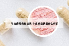 牛皮癬種類和癥狀 牛皮癬癥狀是什么樣的