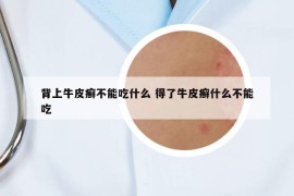 背上牛皮癬不能吃什么 得了牛皮癬什么不能吃
