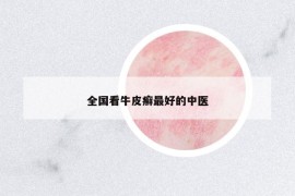 全國看牛皮癬最好的中醫(yī)