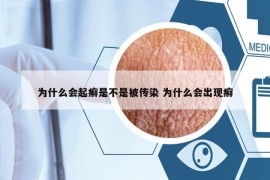 為什么會起癬是不是被傳染 為什么會出現(xiàn)癬