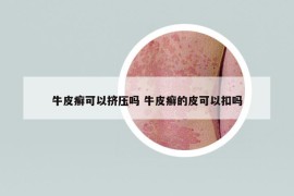 牛皮癬可以擠壓?jiǎn)?牛皮癬的皮可以扣嗎