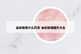 油皮癬用什么藥膏 油皮膚病圖片大全