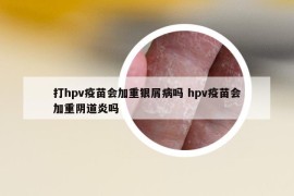 打hpv疫苗會(huì)加重銀屑病嗎 hpv疫苗會(huì)加重陰道炎嗎