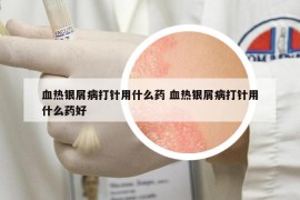 血熱銀屑病打針用什么藥 血熱銀屑病打針用什么藥好