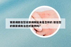 銀屑病膿包型皮膚病剛起來是怎樣的 膿包型的銀屑病有治愈的案例嗎?