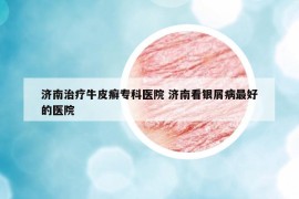 濟(jì)南治療牛皮癬?？漆t(yī)院 濟(jì)南看銀屑病最好的醫(yī)院